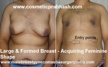 gynecomastia surgery large man Breast 