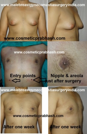 gynecomastia surgery before after moderate size