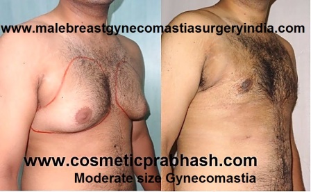 Male breast reduction before after Delhi