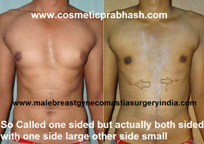 gynecomastia-unilateral-before-after