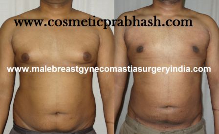 gynecomastia surgery abdomen liposuction