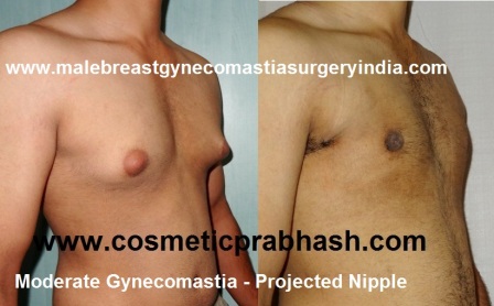 moderate male breast reduction surgery before after
