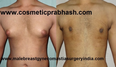 male breast reduction before after small to moderate