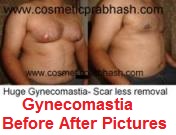 gynecomastia-surgery-before-after-pictures