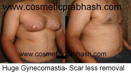 gynecomastia treatment before after