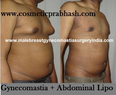 gynecomastia male chest fat & abdomen fat removal