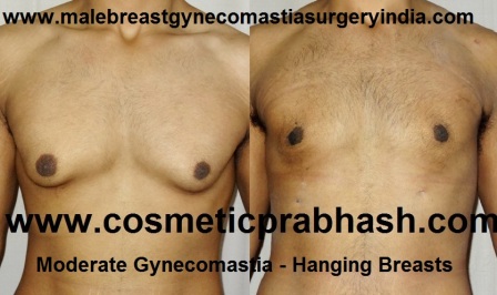 small saggy gynecomastia surgery before after