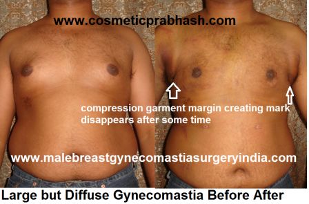 male breast gynecomastia surgery before after