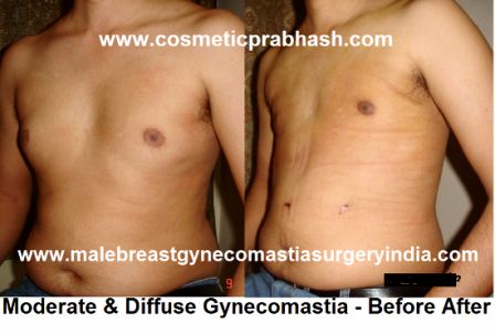 gynecomastia surgery before after moderate diffuse